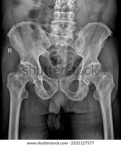 Sharp X-ray image of the human pelvis, revealing the ilium, ischium, pubis, and sacrum, essential for assessing pelvic fractures and abnormalities. Royalty-Free Stock Photo #2331127577
