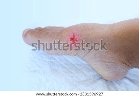 closeup of weeping wound, trophic ulcer on female leg, wound exudate prevents healing ulcers by destroying growth factors, concept of eliminating inflammatory process, sanitation pathogenic microflora Royalty-Free Stock Photo #2331596927