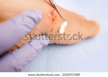 doctor treats weeping wound, trophic ulcer on female leg, wound exudate prevents healing ulcers by destroying growth factors, concept eliminating inflammatory process, sanitation pathogenic microflora Royalty-Free Stock Photo #2332957489