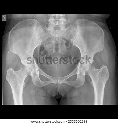 X -ray image of normal healthy hip joints pelvis 