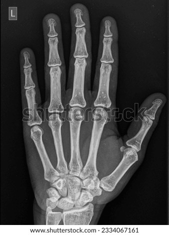 Hand x ray ap view left hand