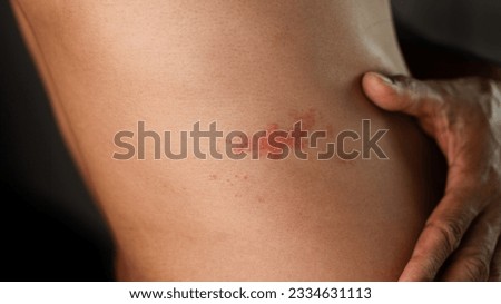 Man with shingles disease, skin infected with Herpes zoster, virus, Healthcare and medical. Royalty-Free Stock Photo #2334631113