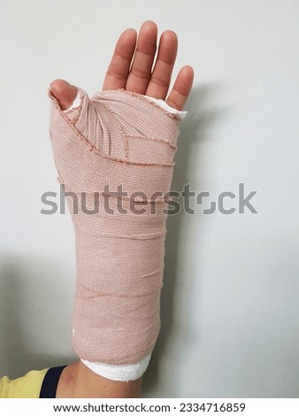 Carpal Tunnel Syndrome post-operative, on a heavy bandage (splint).