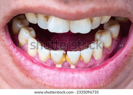 Tooth's a man smoking bad. woman smokes a cigarettes have tooth decay and calculus on teeth, So we should be care dental with the hygiene. Royalty-Free Stock Photo #2335096735