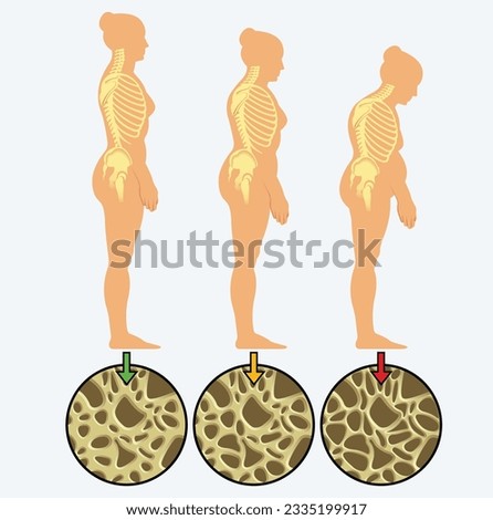 Osteoporosis - the progression of osteoporosis and vertebral fractures as a woman ages. Royalty-Free Stock Photo #2335199917