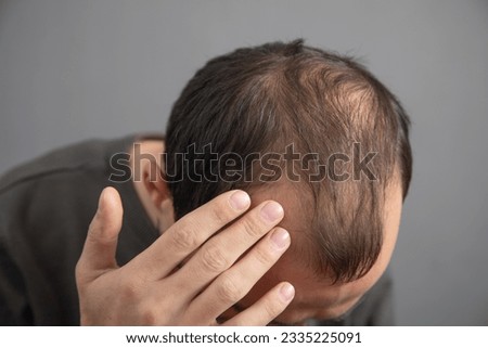 Caucasian man. Hair loss problem  Royalty-Free Stock Photo #2335225091