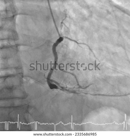 Percutaneous Coronary Intervention in cardiac catheterization laboratory. Royalty-Free Stock Photo #2335686985