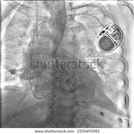 x-ray image of permanent pacemaker implant in chest body with stent