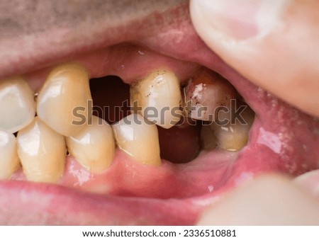 Missing teeth and dental problems in a caucasian man close-up Royalty-Free Stock Photo #2336510881