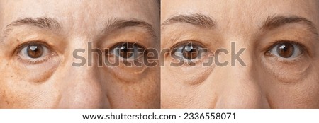 Xanthelasma on all 4 eyelids of a 55 years old woman, before and after applying camouflage make-up on lower and eye shadow on the spots of upper lids. Royalty-Free Stock Photo #2336558071
