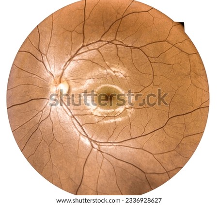 View inside human eye disorders - showing retina, optic nerve and macula.Retinal picture ,Medical photo tractional (eye screen) concept.