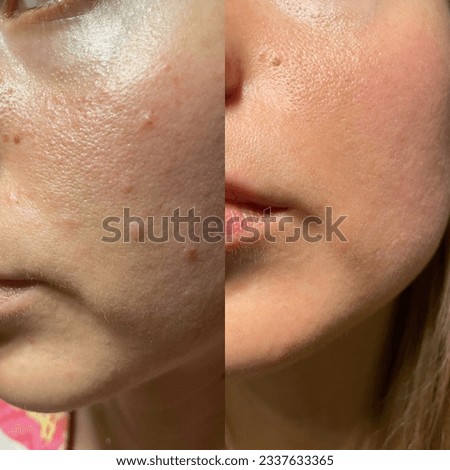 check skin and acne closeup. Pimple before after Royalty-Free Stock Photo #2337633365