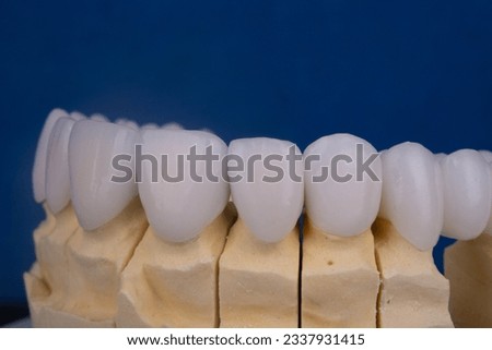 Model with dental veneers created by the dental technician Royalty-Free Stock Photo #2337931415