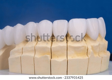 Model with dental veneers created by the dental technician