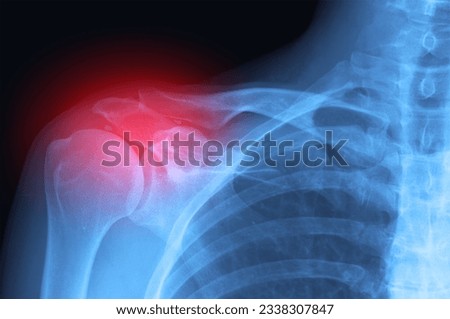 Real X-ray scan - inflammation or broken arm and shoulder trauma pain. Radiology diagnosis. Royalty-Free Stock Photo #2338307847