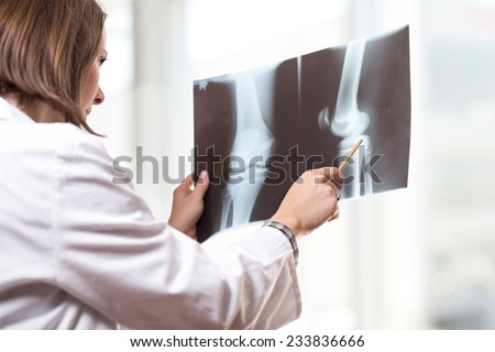 Young female doctor looking at the x-ray picture of knee injury in hospital