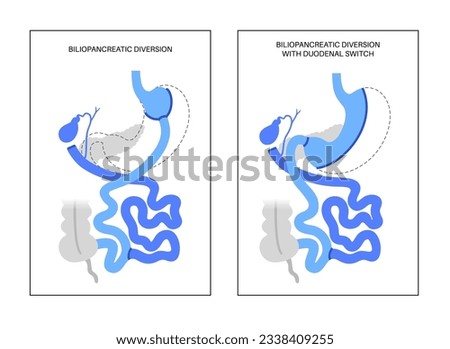 Biliopancreatic diversion with duodenal switch. BPD stomach surgery, weight loss gastric procedure. Internal organs before and after operation. Overweight and obesity problem flat vector illustration