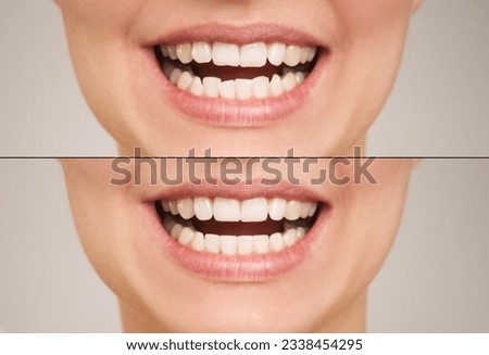close-up photo of female teeth before and after the installation of the bracket system. The concept of comparison. Dentistry and orthodontics. The result of bite correction. Royalty-Free Stock Photo #2338454295