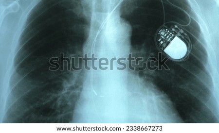 Doctor Examining X-Ray Image of Chest with Artificial Cardiac Pacemaker Implant Royalty-Free Stock Photo #2338667273