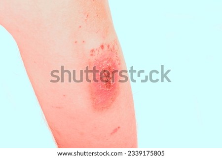 white background. a human hand. Terrible burns on a woman's hand. Royalty-Free Stock Photo #2339175805