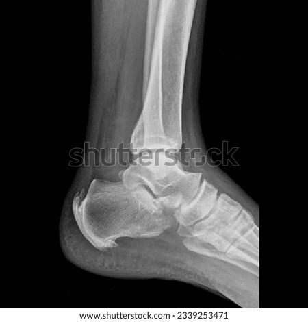 X ray image of ankle joint lateral show heel spur syndrome ,calcaneal spur,heel bone