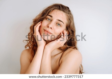 Portrait of a beautiful young woman with inflammations on the skin of her face. Medicine and cosmetology. Smiling woman with problem skin on a sunny day. Copy space. Royalty-Free Stock Photo #2339777317