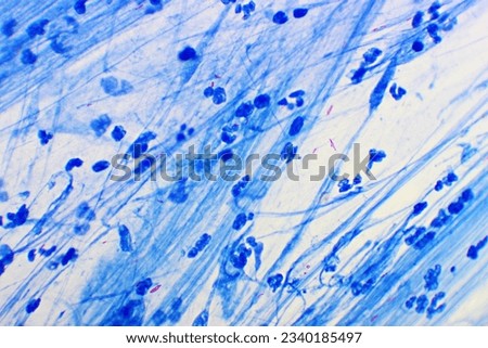 Mycobacterium tuberculosis positive (small red rod) in sputum smear, acid-fast stain, analyze by microscope 1000x Royalty-Free Stock Photo #2340185497