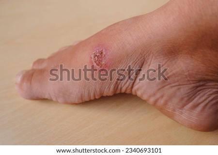 closeup of weeping wound, trophic ulcer on female leg, wound exudate prevents healing ulcers by destroying growth factors, concept of eliminating inflammatory process, sanitation pathogenic microflora Royalty-Free Stock Photo #2340693101