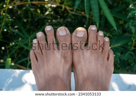Oct.14th 2022 Uttarakhand, India. Neglected foot nails of an Indian adult with unhygienic feet conditions. Concept of self-care and personal hygiene. Royalty-Free Stock Photo #2341053133