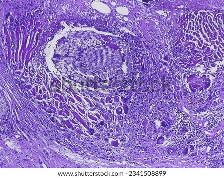 Multinucleated foreign body giant cells (FBGCs) in Hematoxylin and eosin staining tissues Royalty-Free Stock Photo #2341508899