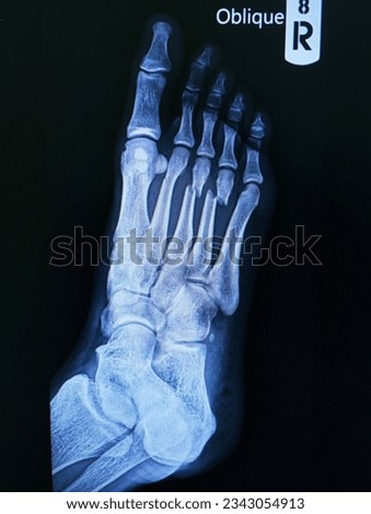 x-ray foot Oblique view showing fracture neck of metatarsal bone Medical image concept.