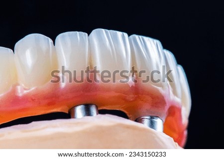 dental photography of full arch zircon bridge on implants Royalty-Free Stock Photo #2343150233