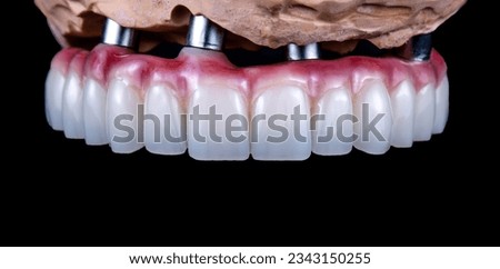 dental photography of full arch zircon bridge on implants Royalty-Free Stock Photo #2343150255