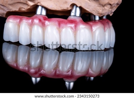 dental photography of full arch zircon bridge on implants Royalty-Free Stock Photo #2343150273