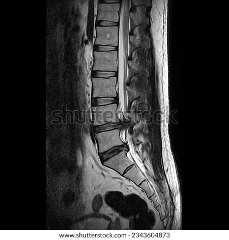 Medical picture. herniated disc m.r.i scan lumbar spine in position of L4-L5 and L5-S1 are very painful. patient, resonance, radiology