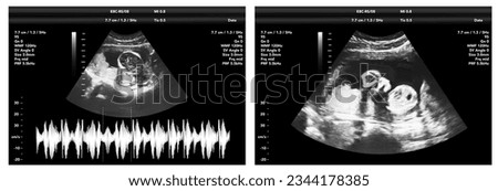 pregnancy ultrasound film genecology sonogram, baby medical ultra scan diagnostic control Royalty-Free Stock Photo #2344178385