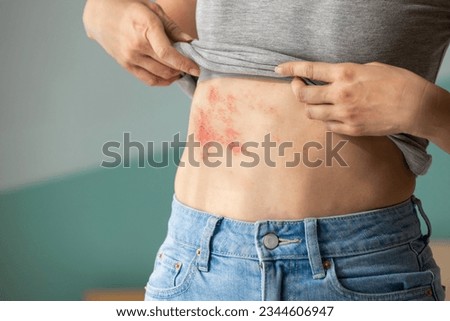 Woman with shingles on the skin she feels very painful Royalty-Free Stock Photo #2344606947