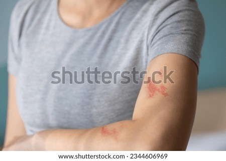Woman with shingles on the skin she feels very painful Royalty-Free Stock Photo #2344606969