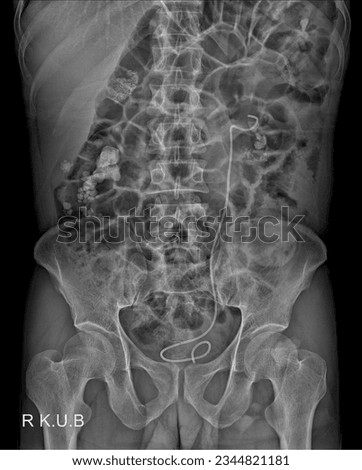 Assessment of Renal Calculi with KUB X-ray