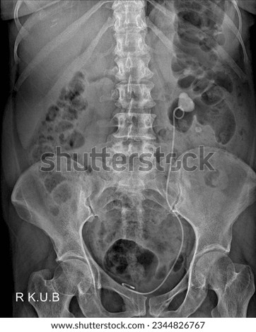 Evaluation of Lower Urinary Tract Obstructions using KUB X-ray Royalty-Free Stock Photo #2344826767