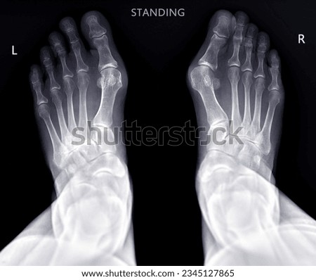 Foot x-ray image  AP  standing view  isolated on black background. Royalty-Free Stock Photo #2345127865