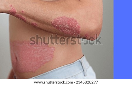 
Eczema, also known as atopic dermatitis, is a chronic skin condition characterized by inflammation, redness, itching, and sometimes the development of small fluid-filled blisters.  Royalty-Free Stock Photo #2345828297