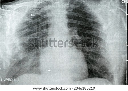 Plain x ray chest showing infectious pulmonary process pneumonia with right side minimal para-pneumonic effusion, right sided aspiration pneumonia that could be complicated to empyema Royalty-Free Stock Photo #2346185219