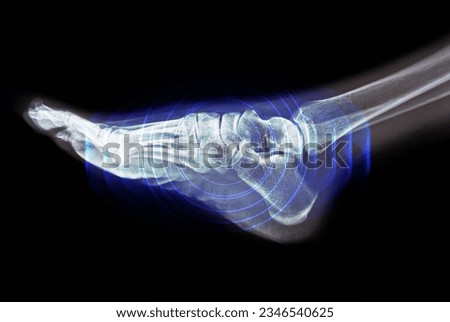 Foot pain on x-ray on black background Royalty-Free Stock Photo #2346540625