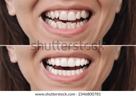 Cropped shot of young caucasian woman before and after veneers installation. The result of teeth whitening. Dentistry, dental treatment. Сorrection of uneven teeth with braces. Comparison, difference Royalty-Free Stock Photo #2346800781