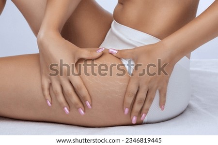 A woman after weight loss shows stretch marks on the skin of her legs and the outer and inner side of the thighs. Treatment of skin stretch marks in the clinic. Royalty-Free Stock Photo #2346819445