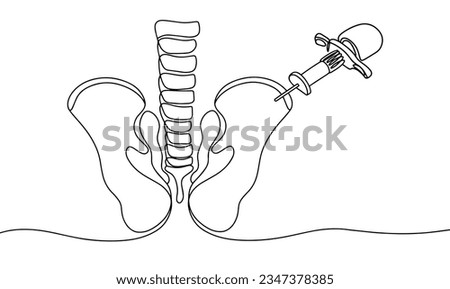 Puncture of the bone marrow from the posterior iliac crest of the pelvis. World Marrow Donor Day. One line drawing for different uses. Vector illustration. Royalty-Free Stock Photo #2347378385