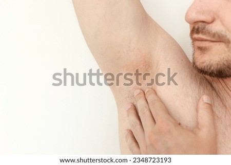 Young man shows irritation on the sensitive skin after using a razor, trimmer, toxic deodorant or antiperspirant. Armpit rash. Allergy, irritation or atopic dermatitis. Acne or red spots underarm Royalty-Free Stock Photo #2348723193