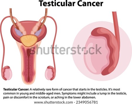 Illustration of male anatomy with testicular cancer