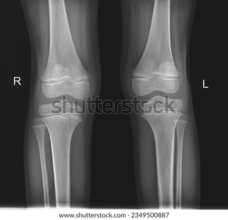 Film x-ray of human child both knee normal joints and ligaments Medical image concept. Royalty-Free Stock Photo #2349500887